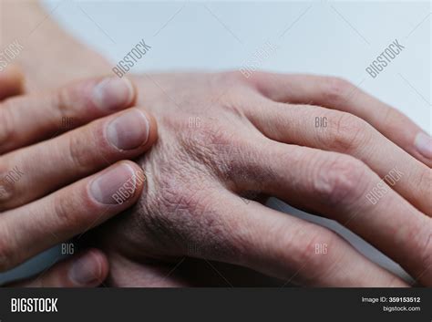 man sick hands dry image photo  trial bigstock