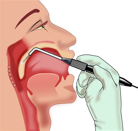 sleep apnea pillar procedure