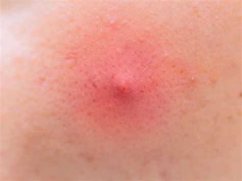armpit pimple types   treatments