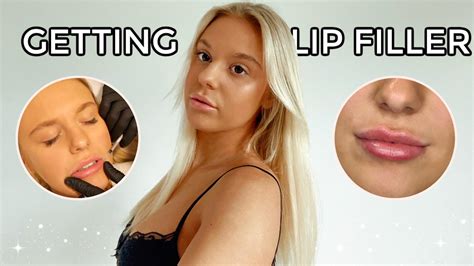 Getting Lip Filler For The First Time The Full Experience Youtube