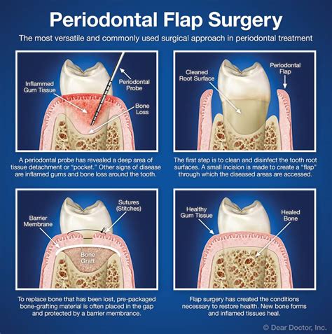 periodontal flap surgery britten perio