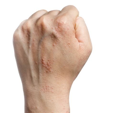 white itchy marks   skin   hands healthfully