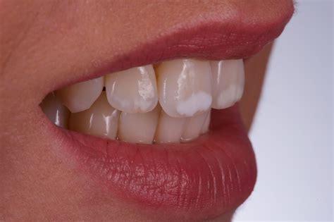 mp tandartsen uit apeldoorn uw witte vlekken laten verwijderen