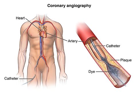 Cardiac Catheterization Johns Hopkins Medicine Health Library