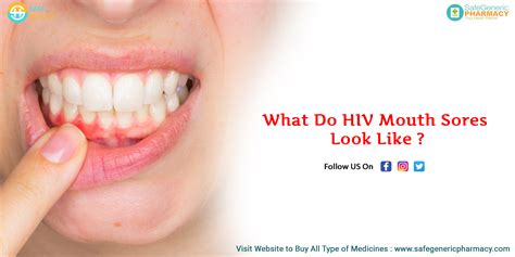 What Do Hiv Mouth Sores Look Like Reca Blog