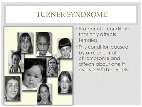 Pervasive Developmental Disorders Turner Syndrome Klinefelters Syn…