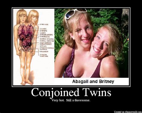 Conjoined Twins Picture Ebaum S World
