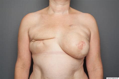 xxx pics women with mastectomy teen porn tubes