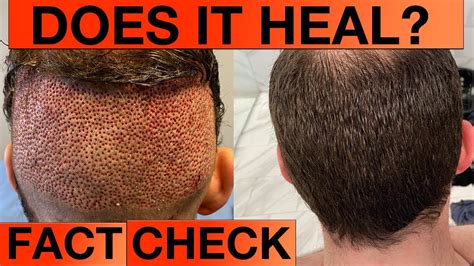 hair transplant donor area month    heal youtube