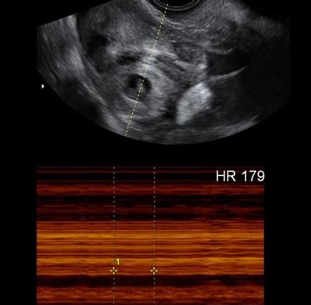 fetal heart beat radiology reference article radiopaediaorg
