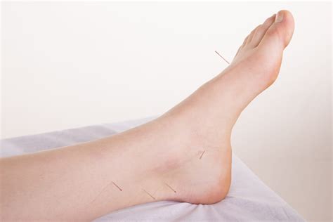 Acupuncture For Plantar Fasciitis Foot And Heel Pain Relief