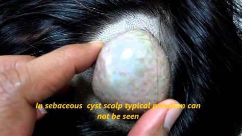 sebaceous cyst  head huge youtube