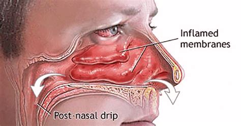 17 Home Remedies For Blocked Nose Or Stuffy Nose The Discover Reality