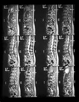 Spinal Nerve Stenosis