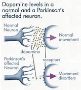 Photos of Diagnosis Test For Parkinson''s Disease
