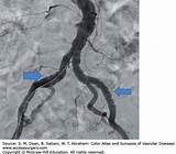 Fibromuscular Dysplasia Carotid Artery Pictures