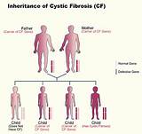 How Is Cystic Fibrosis Diagnosed Pictures