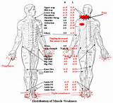 Pictures of Upper Back Nerve Damage Symptoms