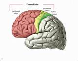 Images of Frontal Lobe Brain Tumor