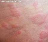Skin Rash Diagnosis Pictures Photos