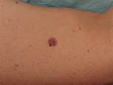 Photos of Early Signs Of Melanoma