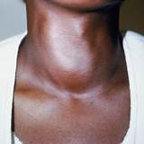 Thyroid Tumor Symptoms Pictures