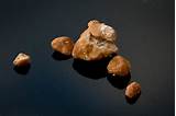 Kidney Stones Different Types Images