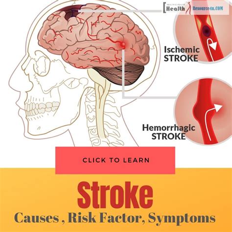 Stroke Causes Risk Factor Symptoms And Treatment