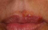 Photos of Herpes Medication Online