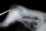 Photos of Congenital Imperforate Anus