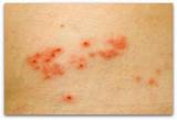 Pictures of Shingles Symptoms Of