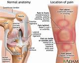 Pictures of Back Surgery Knee Pain