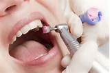 Dental Cleaning Pictures