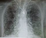 Images of Chronic Lung Disease Symptoms