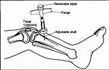 Io Infusion Intraosseous Bone Marrow Needle Aspiration Tibial Proximal Nejm Placement Sternal Into Stepwards Figure Illinois Iliac Location F1 sketch template