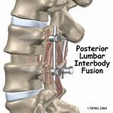 Lower Back Surgery Recovery Time Images
