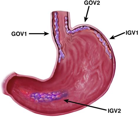 management  gastric varices clinical gastroenterology  hepatology
