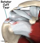 Pictures of What Is A Rotator Cuff Injury