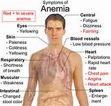Images of Anemia Of Chronic Disease Symptoms