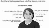 Fetal Alcohol Syndrome Learning Disabilities Images