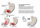 Acute Gastritis Symptoms Pain Pictures
