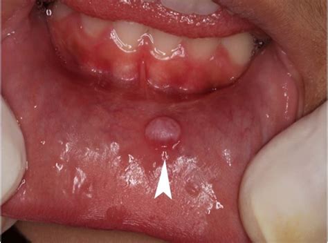 scielo brasil schwannoma of the lower lip mimicking a mucocele in