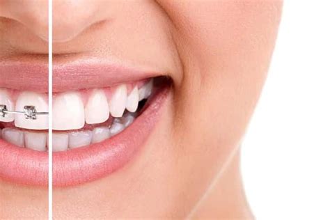veelgestelde vragen  de beugel dentalzorg tandheelkunde