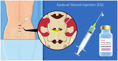 epidural steroid injections spine info