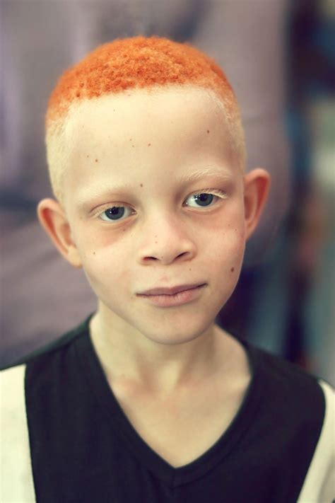 albino people  albino disease news