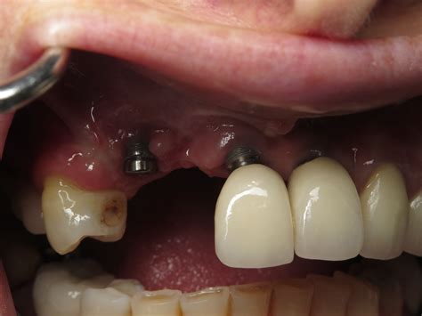 Dental Implants Are Not Permanent Redo S Revisions The Truth