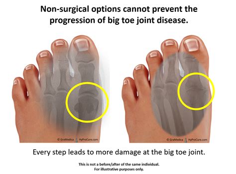 big toe joint pain limitedpainful motion hyprocure  proven