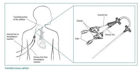 department of surgery vascular access for hemodialysis