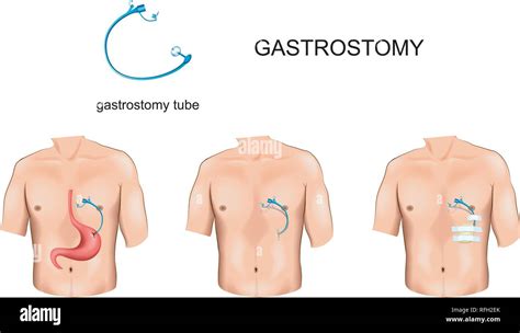 gastrostomy  res stock photography  images alamy