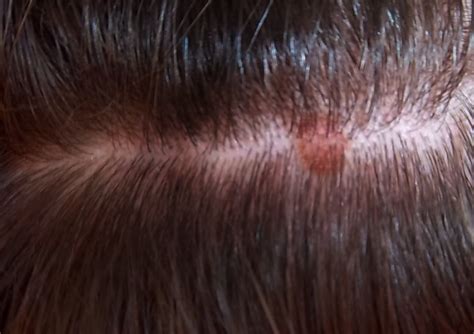 itchy bumps  scalp treatment pictures symptoms  february